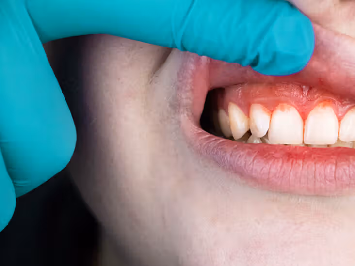 Gums are sensitive tissue