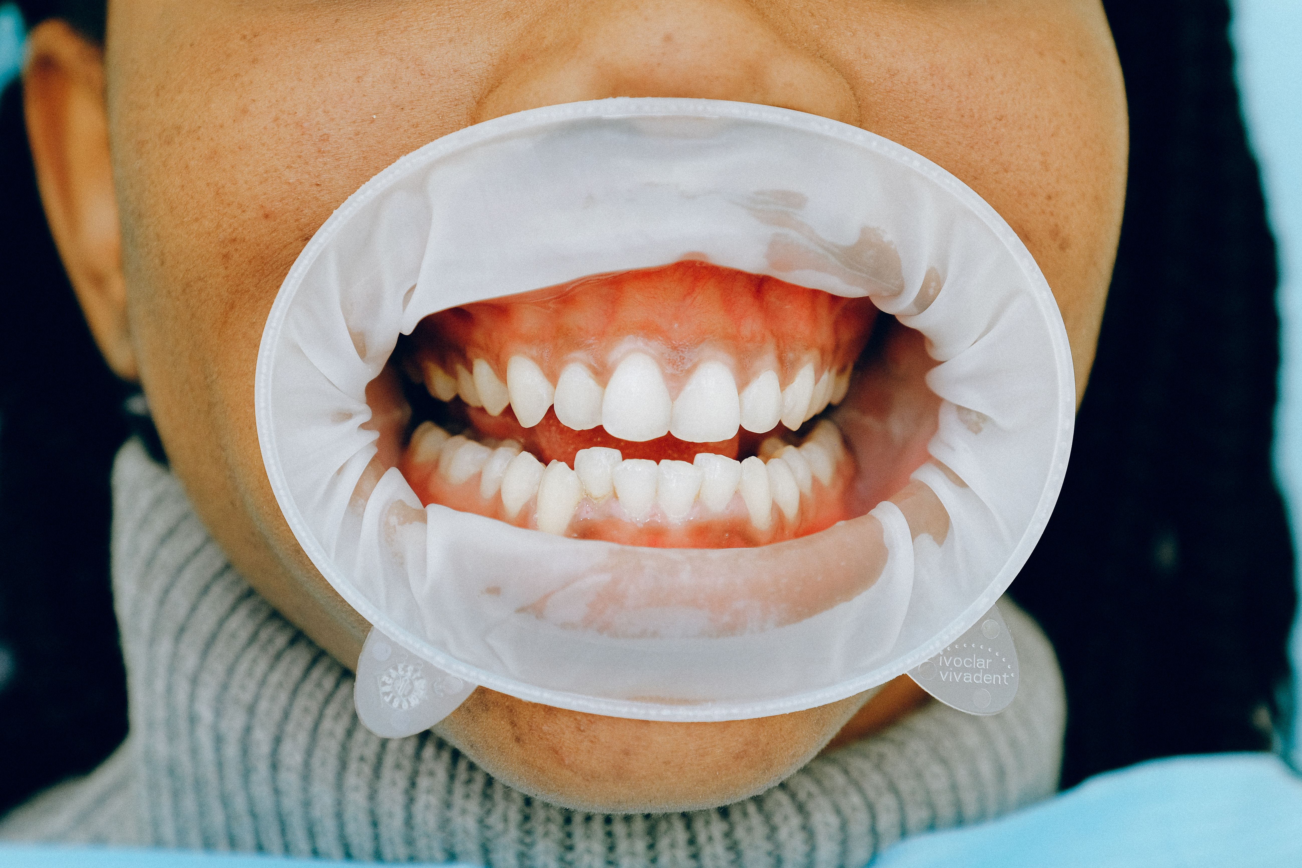 Close-up of a dental examination showing gums during a checkup